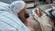 La operación de Neymar fue un éxito y estará afuera de la cancha 10 meses