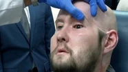 Hito médico: por primera vez realizaron un trasplante de ojo completo